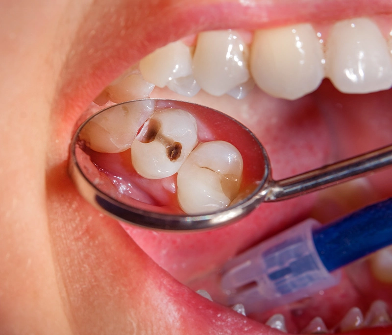 Răng sâu nên bọc răng sứ hay không?